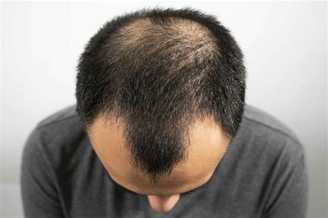 Fda Approved Hair Loss Treatments For Androgenic Alopecia Hairscience