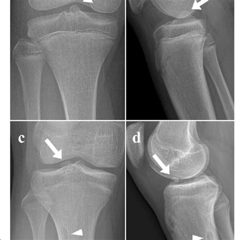 A A Radiograph Of A 10 11 Year Old Girl With Tibial Eminence Fracture