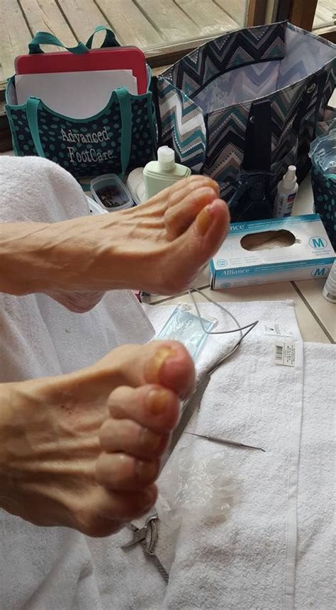 Before And After Advanced Foot Care Nurse And Wellness Foot Care