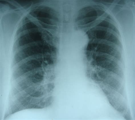 Pulmonary Edema X Ray Acute Pulmonary Edema Image
