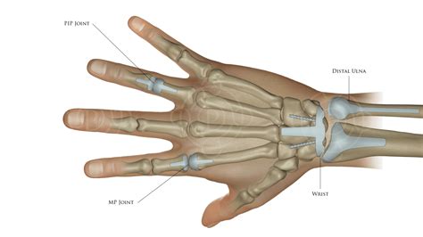 West Palm Beach Hand Rheumatoid Arthritis Treatment Surgery Wellington