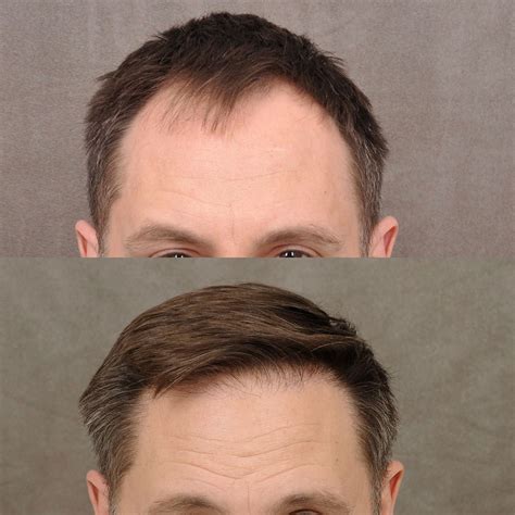 Hair Transplants Before And After