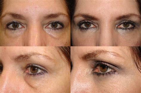 The Art Of Lower Blepharoplasty It Requires A Specialist With