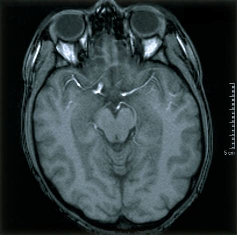 Normal Brain 2 Axial Mri Scan Wellcome Collection