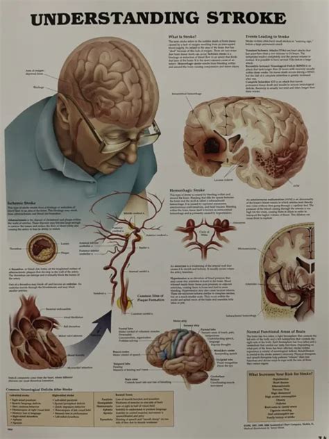 ANATOMICAL CHART Understanding Stroke Anatomy Poster 2 00 PicClick