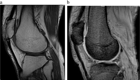 Sagittal T W A And Proton Density Fat Saturated B Images Of Knee Download Scientific
