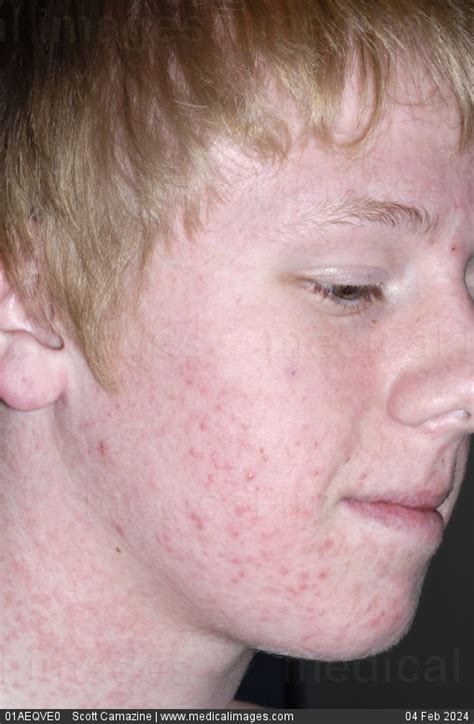 Stock Image Close Up Of A Skin Rash Due To An Allergic Reaction To The