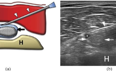 Ultrasound Guided Biceps Tendinitis And Rotator Cuff Tendinitis