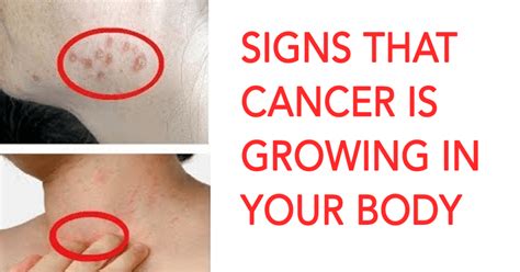 Of course, in order to be treated, you have to know you have the problem in the first place. 7 Early Warning Signs And Symptoms Of Cancer Most People ...