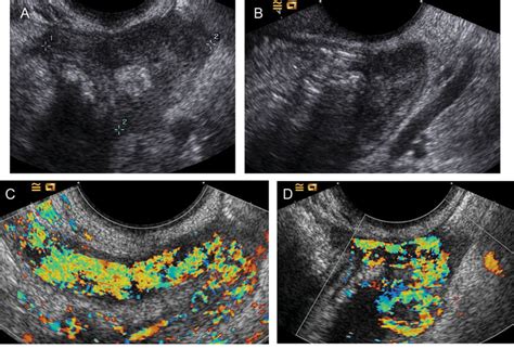 Ultrasound Images From One Patient With Moderate Acute Salpingitis Download Scientific Diagram