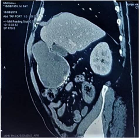 Ct Scan Showing Hydatid Cyst Of The Gallbladder Download Scientific