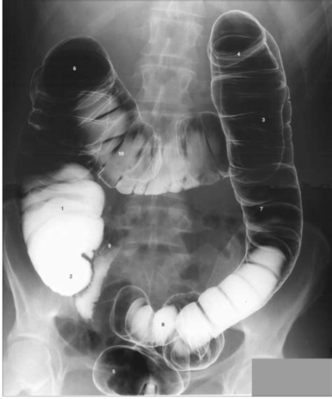 Abdomen Double Contrast Barium Enema Of Large Bowel Colon Diagram