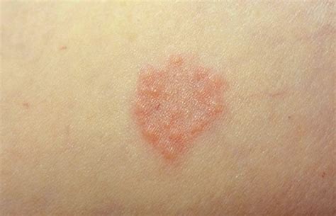 Granuloma Annulare Pictures Causes Contagious Symptoms Treatment