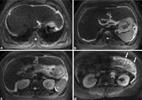 Diffuse Infiltrative Carcinomatosis Diffusion Weighted Image