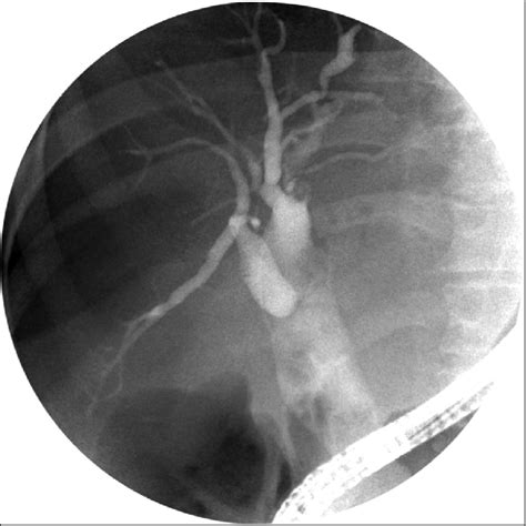 Ercp Demonstrating A Markedly Dilated Cbdchd 36 Mm In Diameter With