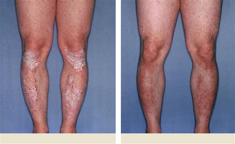 Plaque Psoriasis Pictures Before And After Humira® Adalimumab