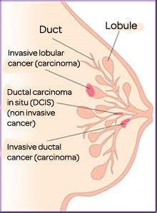 Breast cancer is the most commonly diagnosed cancer in females in australia, and the third most there are many different types of breast cancer. Iam a mother: TYPES OF BREAST CANCER