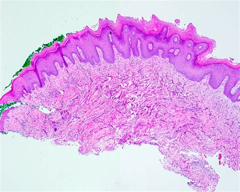Proliferative Verrucous Leukoplakia Histology