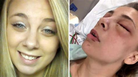 us woman receives prosthetic eyeballs after gouging out eyes while on meth au