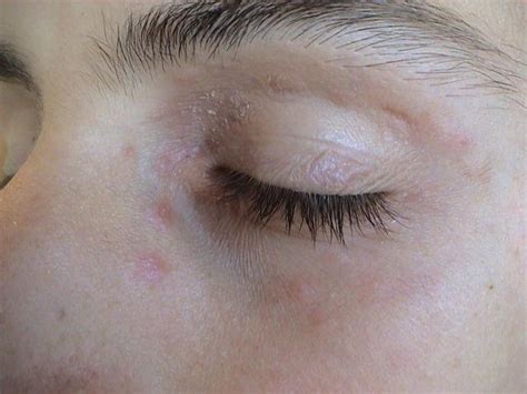 Dermatitis Ekzema Dermatitis Of The Eyelids Picture Hellenic