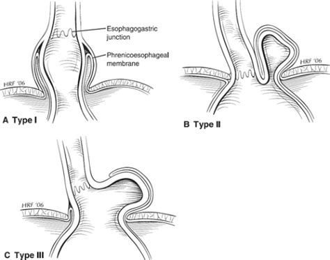 Classification Of Hiatal Hernias Paraesophageal Hernia Open I Cloud The Best Porn Website