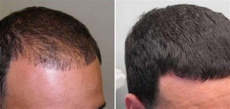 The solution form requires an applicator to be applied safely onto the hair. By using minoxidil, is new hair growth permanent or ...