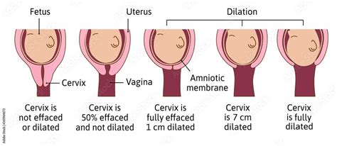 Cervical Effacement And Dilation During Labor Or Delivery Cervix Changes From Not Effaced And