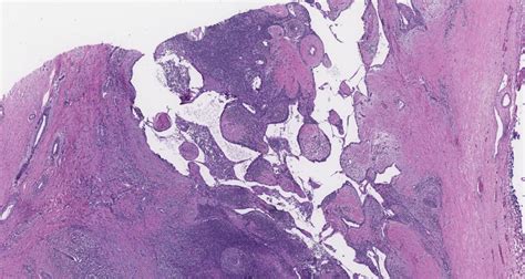 Classic Hodgkin Lymphoma Involving The Thymus With Associated Thymic