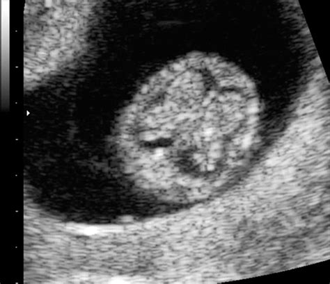 First‐trimester Sonographic Diagnosis Of Holoprosencephaly Sepulveda