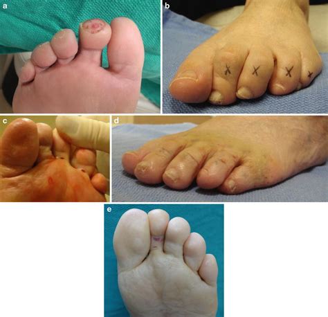 Osteomyelitis Of The Central Toes Musculoskeletal Key