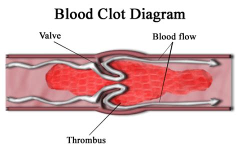 What Is The Difference Between Thrombus And Postmortem Clot Compare
