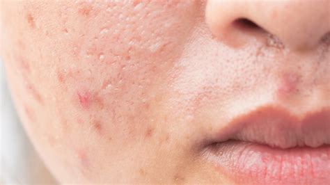 How To Treat An Infected Pimple Gladskin