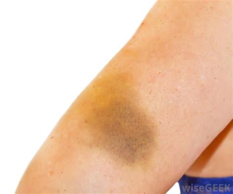 Pinching Bruises Upper Arm Purple Green Yellow What Are Possible
