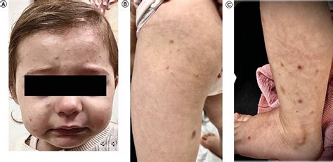 A Case Of Recurrent Vaccine Triggered Gianotticrosti Syndrome Future