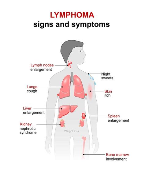 Lymphoma Symptoms 9 Most Important Signs Of Lymphoma Page 9 Of 9