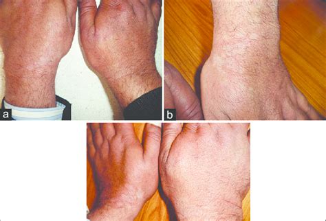 A C Acral Pityriasis Versicolor Multiple Scaly Hypopigmented