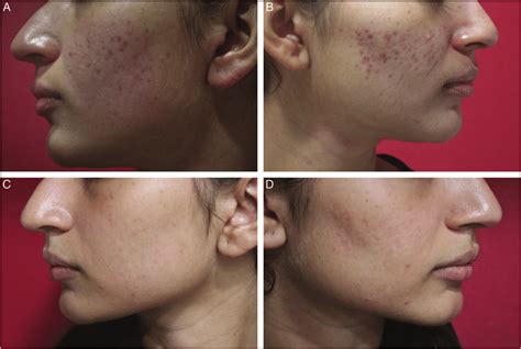 A B Pigmented Erythematous Acne Scars Before C D Pigmented