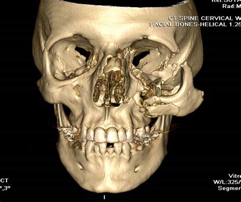 Zygomaticomaxillary complex fracture | Image | Radiopaedia.org