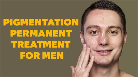 Pigmentation Permanent Treatment For Men Best Dermatologist In Hyd