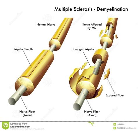 Multiple sclerosis (ms) symptoms, causes, treatment, life expectancy. Multiple Sclerosis Nerve Damage Stock Vector ...