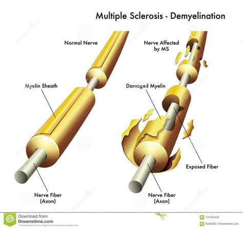 Guidelines from the international panel on the diagnosis of multiple. Multiple Sclerosis Nerve Damage Stock Vector ...