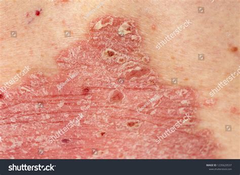 Psoriasis Vulgaris Detail Psoriatic Skin Disease Stock Photo 1235629537