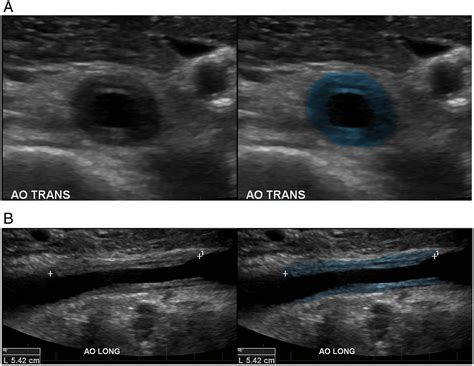 Ultrasound Of Type 4 Takayasus Arteritis With Abdominal Aorta And
