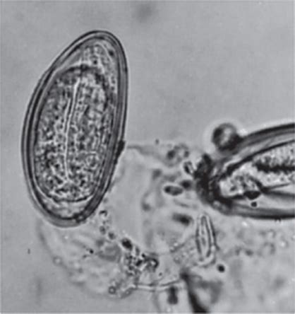 Pinworms Clinical Cases Case Files Pediatrics Lange Case Files