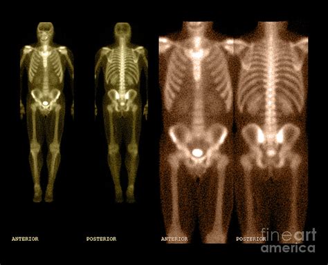 Bone Scan Photograph By Medical Body Scans Fine Art America