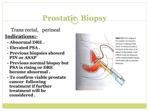 Ppt Localized Prostate Cancer Powerpoint Presentation Free Download