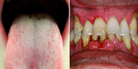 Hiv Positive Mouth Sores Types Of Mouth Sores And Pictures