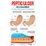 Peptic Ulcer In Children  Causes Symptoms And Treatment