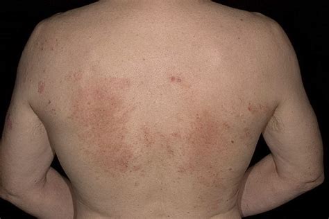 Eczema On The Back Pictures 40 Photos And Images