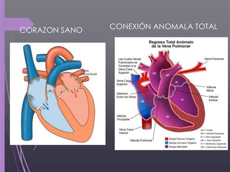 Conexion Anomal Total De Venas Pulmonares Y Sindrome De Ventriculo Iz
